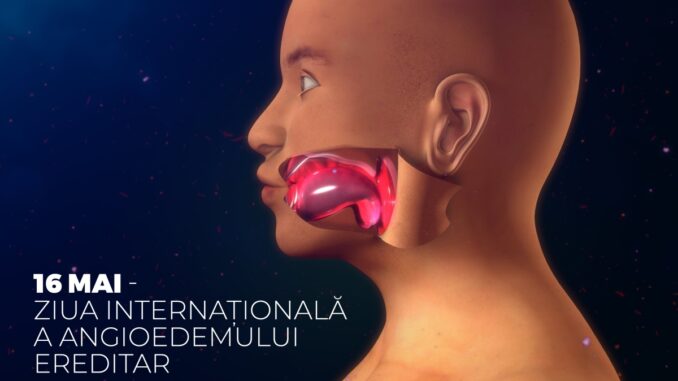 Angioedema 3d illustration
